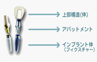 インプラント上部構造