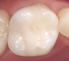 セラミックスインレー(CEREC )