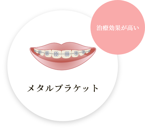 メタルブラケット
